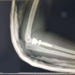 Kolejny nowatorski zabieg w brzeskim szpitalu