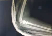 Kolejny nowatorski zabieg w brzeskim szpitalu