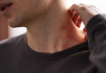 🔸 Łupież pstry – co to jest, jak rozpoznać i diagnozować?