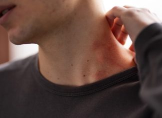 🔸 Łupież pstry – co to jest, jak rozpoznać i diagnozować?
