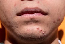 🔸 Skąd się biorą alergie skórne i wysypki?