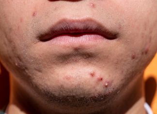 🔸 Skąd się biorą alergie skórne i wysypki?